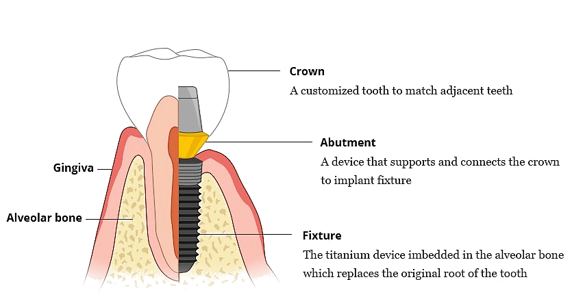 illustratie implantologie